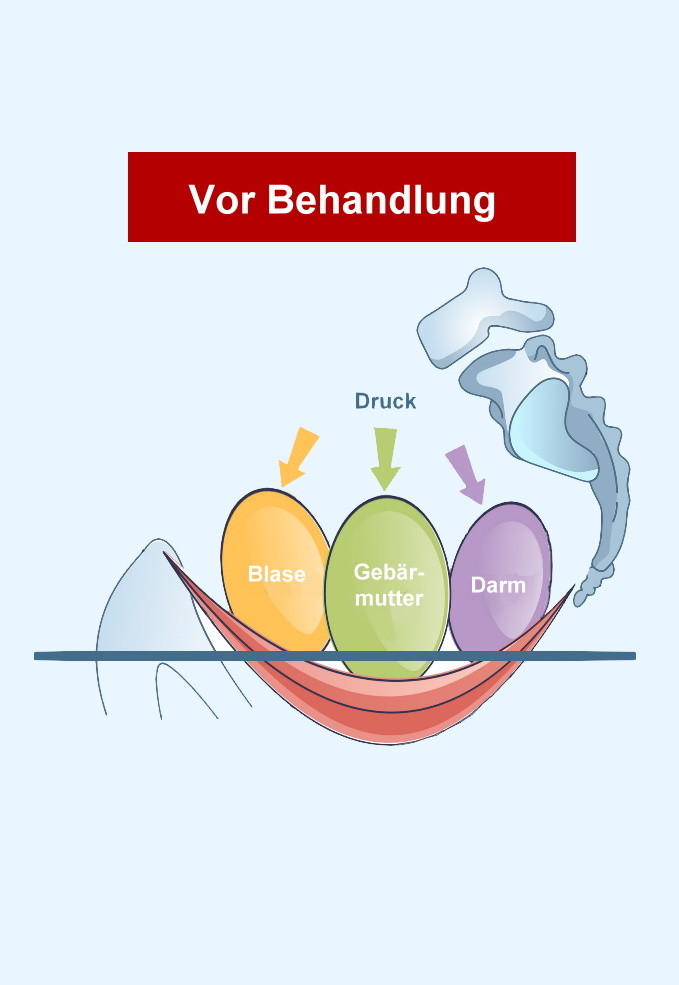 Beckenbodentraining in Bonn